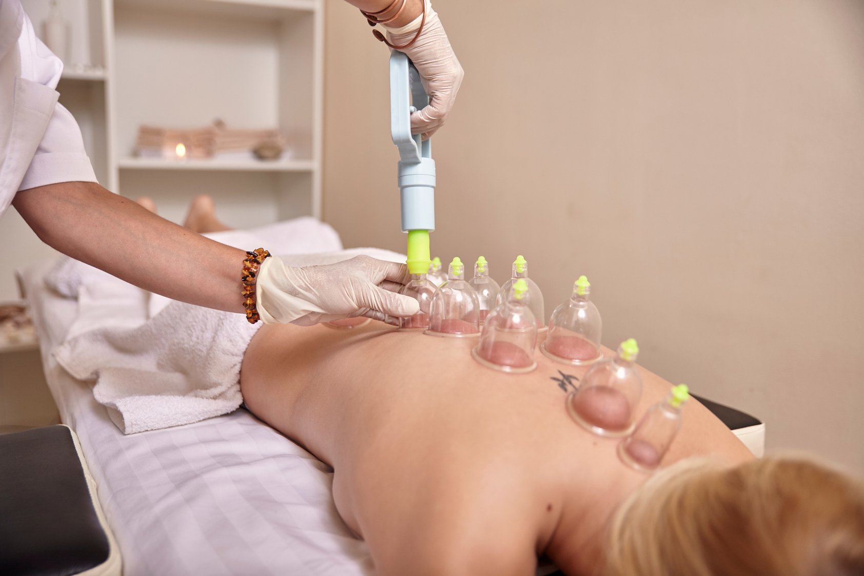 Cupping Therapy